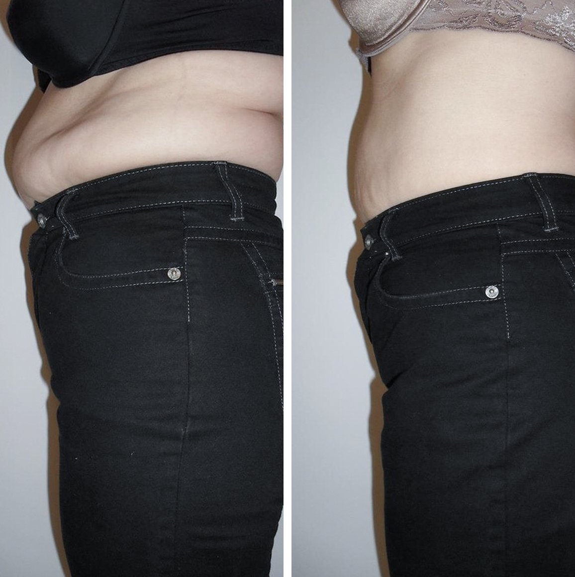 Behandlungsdokumentation BEWEI Body: Bauchpartie im Vorher-Nachher-Vergleich