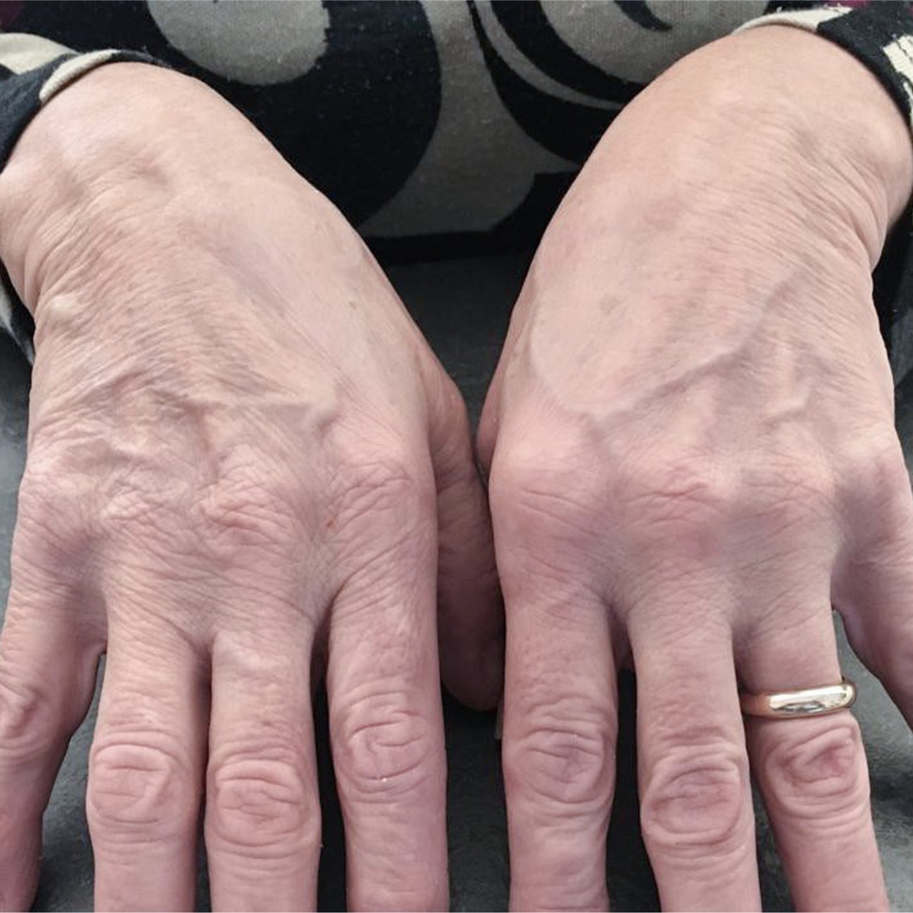 Behandlungsdokumentation BEWEI Hands: beide Handrücken in der Nahaufnahme