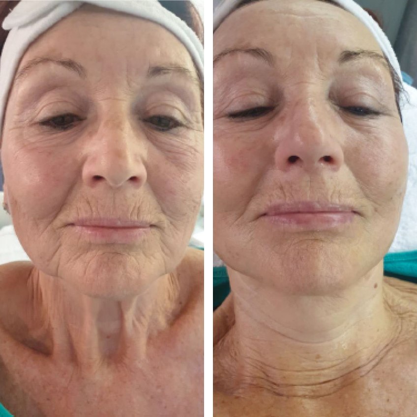 Treatment documentation: face in a before-and-after comparison